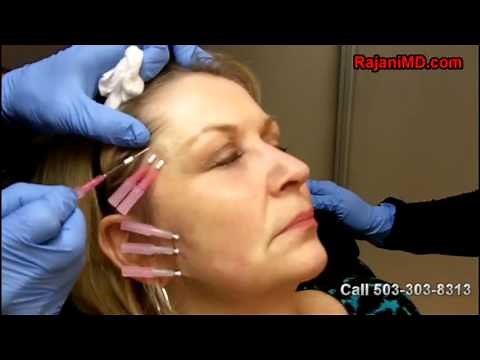 PDO Threads-Eye Lift-DR Rajani
