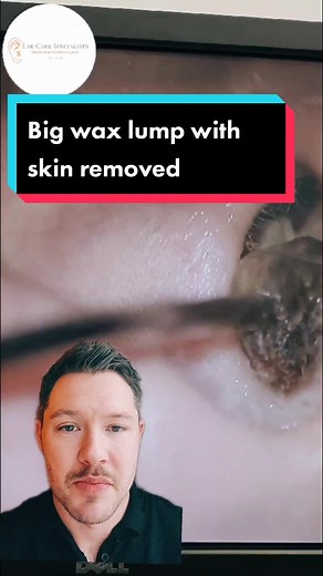 18 Hard wax plug with skin trailing behind. Huge relief for patient. Link in Bio. #Ear #earwax #earwaxremoval #earcleaning #earcarespecialists #audiology #microscope #microsuction #audiologist #nottingham