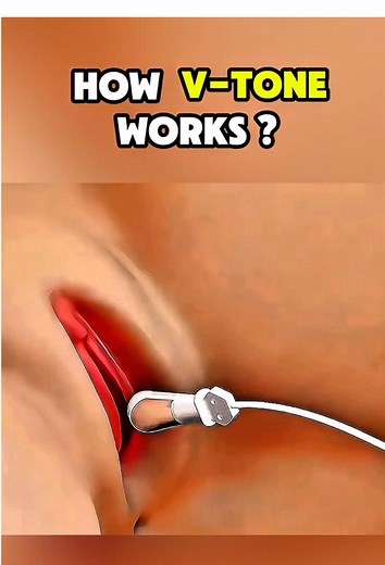 Ever wondered how V-Tone works? 🌸✨ This non-surgical treatment uses gentle electrical muscle stimulation to strengthen the pelvic floor, helping improve bladder control and intimate wellness. #VTone #PelvicHealth #MedicalEducation #WomensWellness #NonSurgicalTreatment Disclaimer: ⚠️ This video is for educational purposes only. It is not medical advice and should not replace consultation with a licensed healthcare provider. Always seek professional evaluation, diagnosis, and treatment for any me