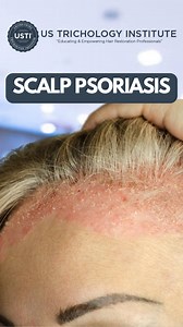 Understanding and Managing Scalp Psoriasis . . . #hairregrowth #hairgrowth #hairloss #haircare #hairlosssolution #thinninghair #hairlosstreatment #hair #alopecia #hairthinning #hairlossproblem #hairvolume #ayurvedichaircare #hairgrowthproducts #hairlosssolution | United States Trichology Institute