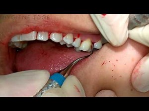 Gracey Instrumentation During Periodontal Therapy