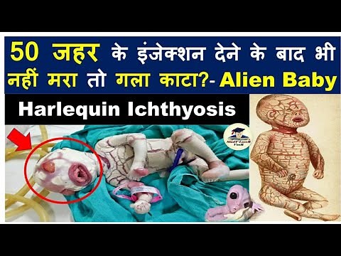 Harlequin Ichthyosis: A severe genetic disorder that affects the skin | Alien Baby #upsc #ias #cse