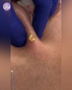 Large Closed Comedones - Whiteheads Extraction In this video you can see a cases of acne mainly manifested by closed comedones, so called whiteheads. Sometimes large amount of content is cumulated so deep under the skin, that it has to be extracted with the use of blade or needle. Comedones that are placed close to surface of the skin can be easily removed through the pore with loop comedone extractor. https://api.whatsapp.com/send?phone=60184600290 Contact No. : 6018-4600 290 Wechat ID : TheLus