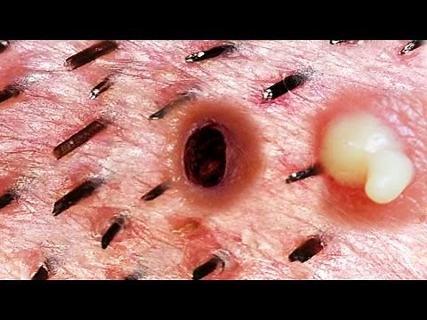 Pimple Popper's Blackheads & Zits Under the Microscope Preview