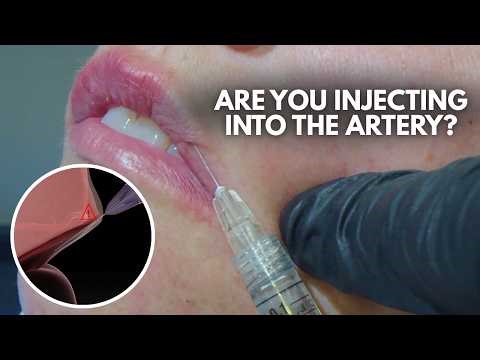 How to inject lips - Avoid the labial artery