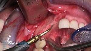 Ridge Splitting Technique