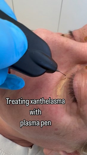 Cholesterol can deposit around the eyes to form fatty, yellowish bumps on or near the eyelid, known as xanthelasma. Cholesterol deposits are soft, flat, yellowish lumps. They tend to appear on the upper and lower eyelids, near the inner corner of the eye, and often develop symmetrically around both eyes. These lesions may remain the same size or grow very slowly over time. They sometimes join together to form larger lumps. Xanthelasmata are not usually painful or itchy. They rarely affect vision