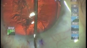 Soft Shell in Cataract Surgery - Eyetube