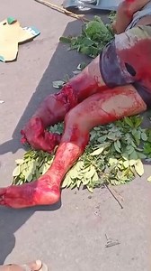 Traffic accident in Brazil leaves pedestrian’s legs completely destroyed