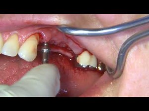 Sinus Lift Vertical Approach/PRF