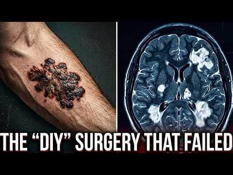 A Farmer Removed His Skin Cancer With A Knife Then This Happened