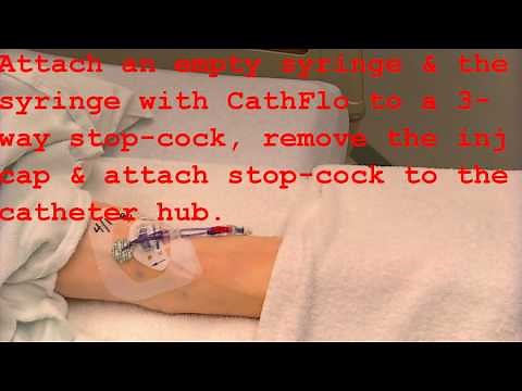 Declotting with CathFlo
