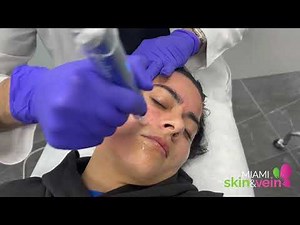 Microneedling with PRP to the face using the SkinPen device by Dr. Shaun Patel in Miami, FL