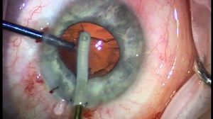 FLACS With SICS and Verisyse Removal - Eyetube