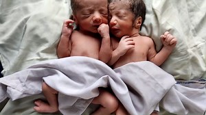 31K views · 306 reactions | Special Twins Newborn babies with multiple anomalies after birth equal to Human Hand(1) | Doctor Give birth | Facebook