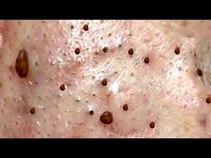 The Most Oddly Satisfying Blackhead Extraction Video