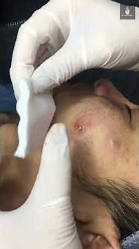 Infected Cyst on Cheek Drained By DR Blackhead !