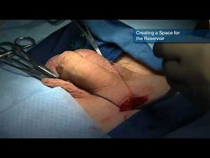 Penile Implant / Prosthesis Surgery - Minimally Invasive Perito Technique
