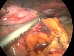 Laparoscopic Hiatal Hernia Repair  • Video • MEDtube.net