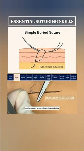 Simple Buried Suture