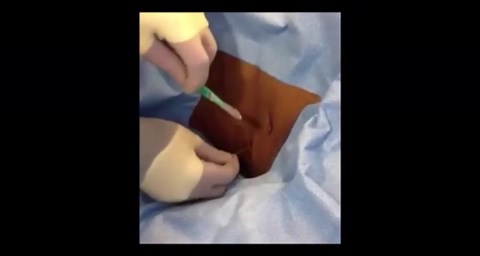 How to Place a Pigtail Catheter