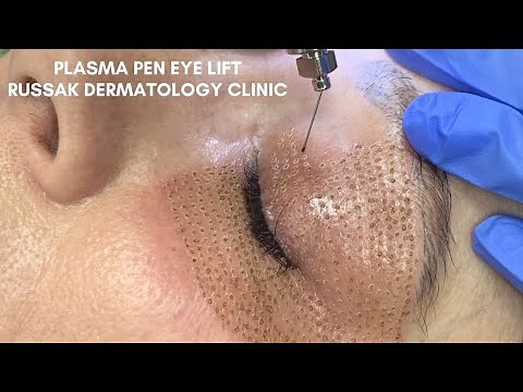 Plasma Pen Eye Lift