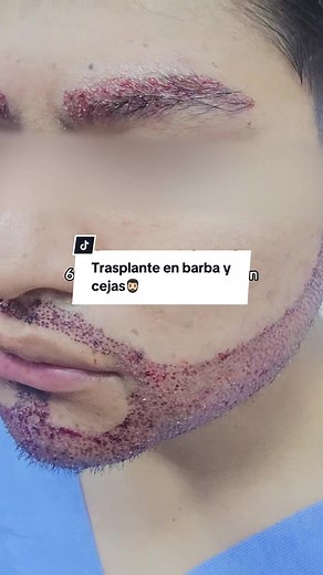 Trasplante de Barba y Cejas: Resultados Inmediatos