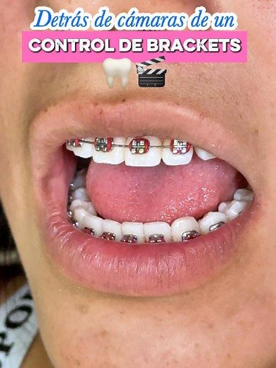 😁 AsÍ realizamos un control de BRACKETS en SONRIE CUENCA. Este mes nuestra paciente eligio el color ROJO para su SONRISA. ✅En SONRIE CUENCA te contamos todo sobre el tratamiento de ORTODONCIA. Cada paciente debe ser guiado por un especialista para la transformacipon de su SONRISA. 👉Si quieres iniciar tu tratamiento y tienes dudas: 📍Visítanos en Cuenca, Av de las Américas y Miguel Cabello Balboa ( Edificio amarillo diagonal a la entrada a Misicata) 📲Ingrese al link de nuestro perfil para envi