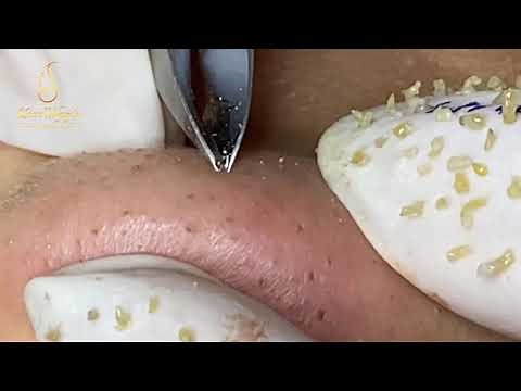Addicted to blackheads on chin, forehead and nose ( 183) | Loan Nguyen