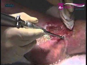 Sonoca-185 in Use on Chronic Wounds