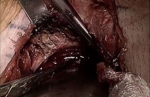 Modified Stoppa Approach for Fractures of the Acetabulum - Cyril Mauffrey, MD