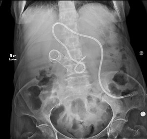 🔴 Malignant gastric outlet obstruction (advanced pancreatic head cancer) ⚡️ Self-expanding metallic duodenal stent in situ (palliation of duodenal obstruction) 📍 Post-pyloric enteric tube (nasojejunal/feeding tube) seen coursing into small bowel, with a loop in the upper abdomen 💡 Overall = palliative decompression enteral nutrition support (often alongside biliary drainage if jaundiced) | إستشاري امراض الباطنة والكبد د محمد الجمال