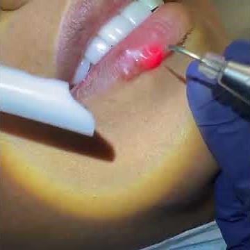 Treatment of a Herpetic Lesion with the Biolase Epic Hygiene Diode Laser