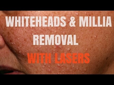 Milia and whiteheads: total face removal:Part 1
