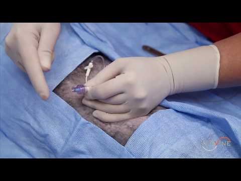 Chest Tube Placement: Over-the-Wire Technique