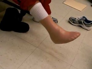 Silicone Partial Foot Prosthesis 2 - Clark & Associates Prosthetics and Orthotics