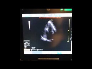 Positive Bubble Study done by POCUS Team