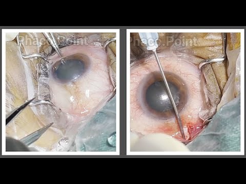 Teach the Technique - The 'Sub tenons' or the 'Episcleral' block to augment a peribulbar block