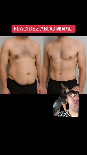 Flacidez Abdominal: Solución O Abdominoplastia?