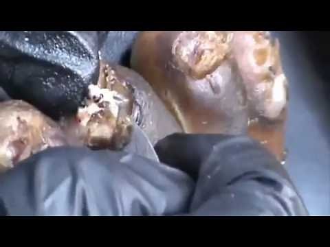 How to remove a jigger from the foot - วิธีการลบ Jigger จาก เท้า P1