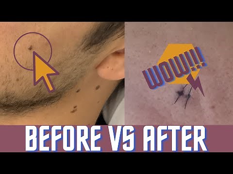 Permanent Mole Removal - Full Surgery