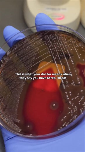 Marilyn | CLS MLS(ASCP) on Instagram: "This is why your throat hole is burning 🔥🥵 Strep throat is caused by the organism Streptococcus pyogenes, also known as Group A strep. On a petri dish, it produces beta hemolysis, meaning it completely lyses the red blood cells in the agar, leaving a clear zone around the colonies. Under the microscope, it appears asgram-positive cocci in pairs and chains, which is a classic morphology. To confirm the identification, we rely on a few key biochemical tests