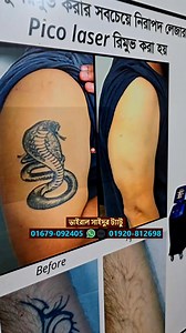 colour tattoo remove. | Rs bd