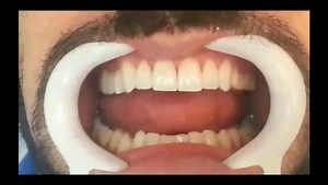 Smile Designer in Venezuela Dr CarrilloHaack dentistry Donde tu Sonrisa mejora tu Autoestima .. . . . . #estheticdentistry #estesthetic #ceramic #veneers#blanqueamiento #porcelainveneers #lentesdecontato #lentesdecontatodental #bogota #caris #caris #paris #Alma Previa Cita 0212 2639753 | Smile designer in Venezuela Dr. Carrillo Haack | Facebook