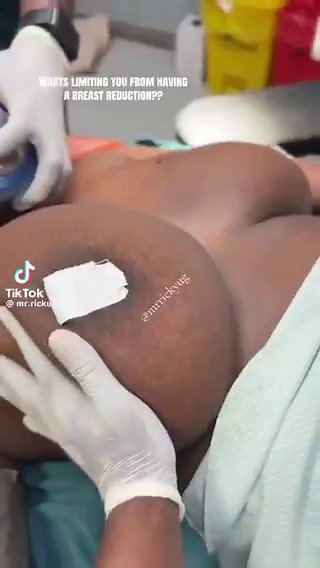 Sos hombre, la reducción de seno no es para vos pedazo de estupido