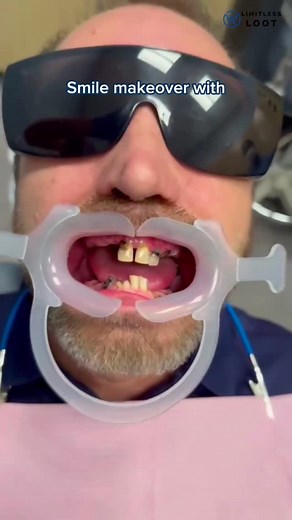 (BUY 1 GET 1 FREE) Silicone adjustable snap-on dentures. At:- limitlessloot.in | Limitlessloot.in