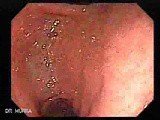 Hyperplastic Polyp - Endoscopy (1 of 8) • Video • MEDtube.net