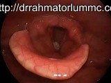 A Mass on The Vocal Cord • Video • MEDtube.net
