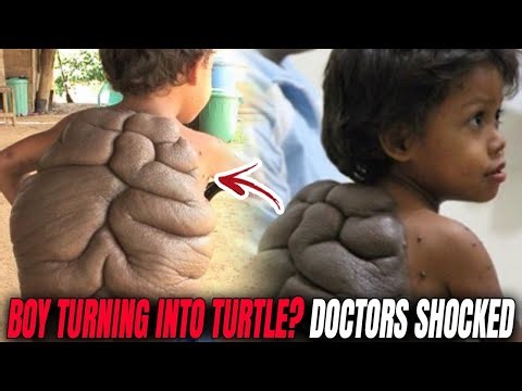 My Son Is Turning Into A Turtle! Mom's Shocking Story! | True story