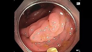 Live Endoscopic Identification of Type I Serrated Polyposis Syndrome